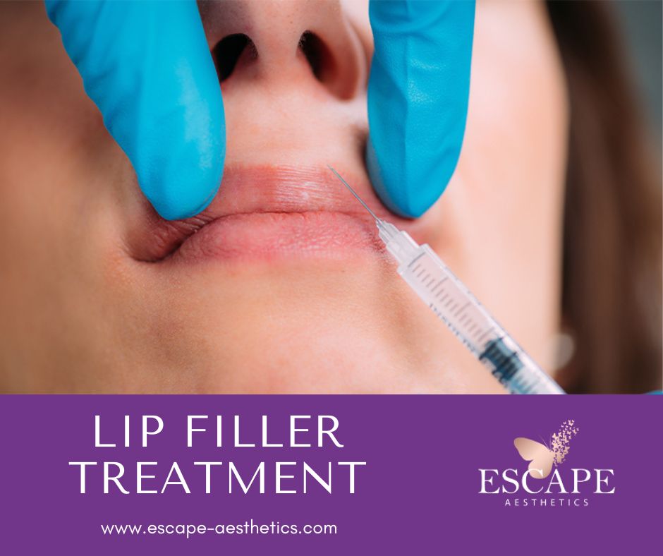 Achieve beautifully enhanced lips with Lip Filler Treatment